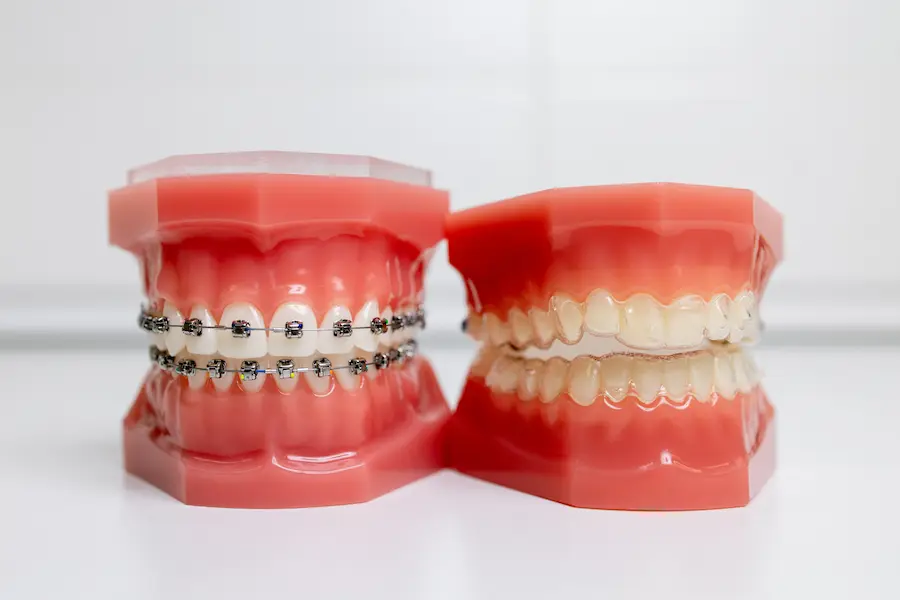 Apparecchi - Studio dentistico Feroci Napoli